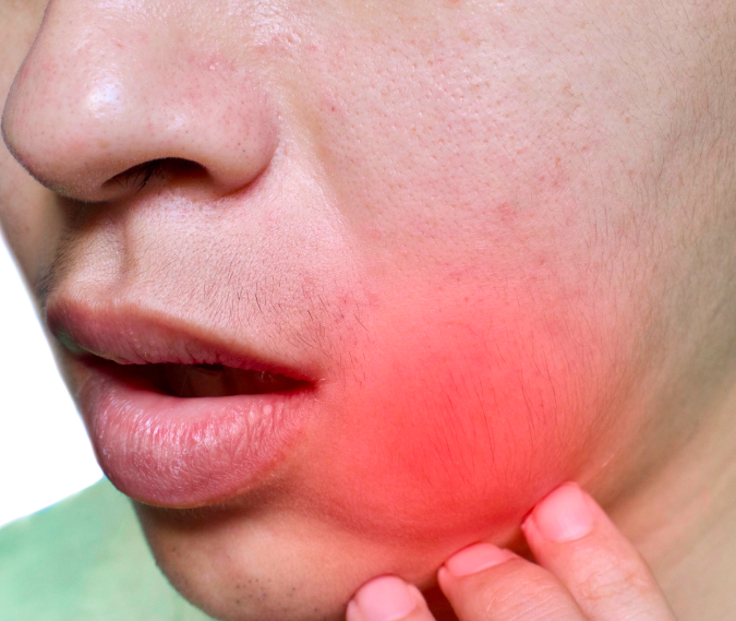 person with a painful swollen cheek as one of the symptoms of chronic pain